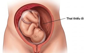 Nguyên nhân, dấu hiệu và cách khắc phục thai thiếu ối